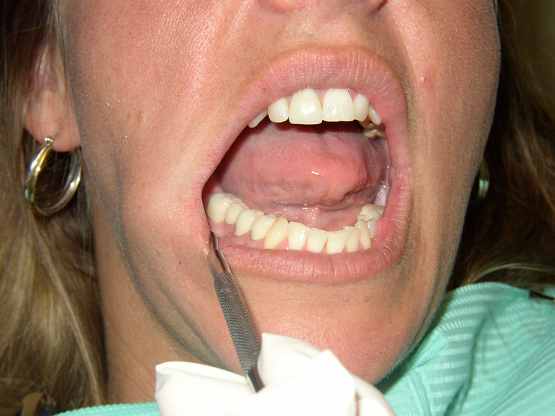 how-to-remove-calculus-from-teeth-how-to-cure-teeth-dentaltown