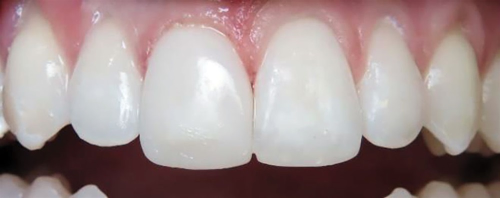 Uveneer: Simplifying Artistic Direct Composite Veneering - Dentistry Today