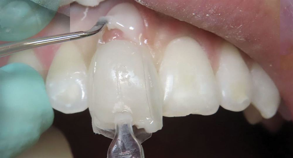 Uveneer: Simplifying Artistic Direct Composite Veneering - Dentistry Today