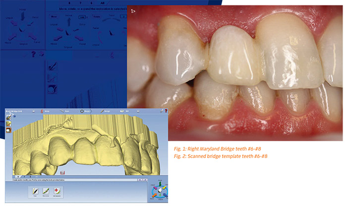 maryland bridge dental pdf
