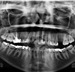Am I Crazy for Considering Extraction of First Molars?