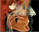 CE Webcast: CBCT in the Treatment of Cranio...