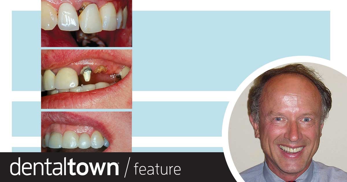 Erupting Compromised Teeth for Restoration Dr. Joe Whitehouse, a proponent of minimally invasive dental procedures, explains when it makes sense to erupt compromised teeth that have very little clinical crown showing, which allows them to be treated with restorative work rather than being replaced with an implant.