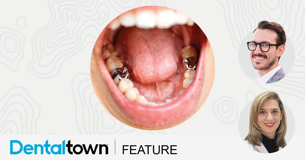 Hi-Ho, Silver! Silver diamine fluoride is mostly used to treat children, but Drs. Justin J. Cardarelli and Marmar Mesgarzadeh believe the caries preventer and treatment makes sense for certain cases of adult patients, too. Their article discusses three such situations and explains how the treatment can be tiered according to the patient’s clinical presentation and follow-up reliability.