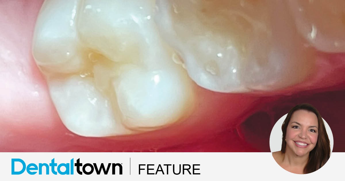 The Future Is Now Dentaltown editorial board member Dr. Jeanette MacLean takes a deep dive on a new product designed to help regenerate tooth enamel and remineralize teeth—a new, aesthetics-friendly bridge in the gap between “watch and wait” monitoring and conventional restorations.