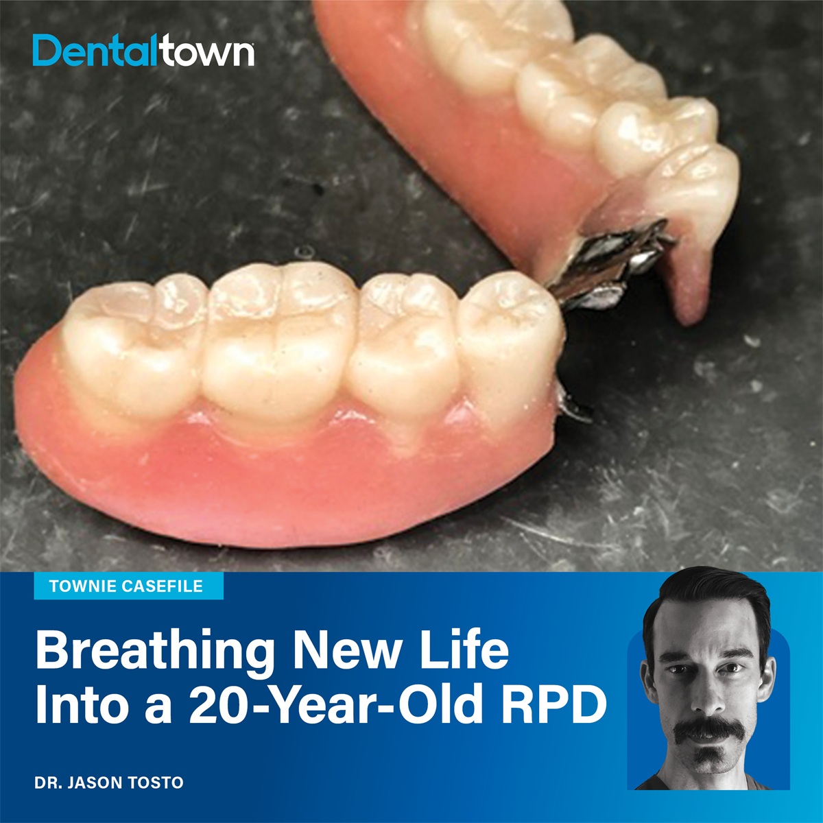 Townie Casefile: Breathing New Life Into a 20-Year-Old RPD Dr. Jason Tosto takes a conservative composite approach to revive a severely worn, 20-year-old RPD while respecting an elderly patient’s limits.