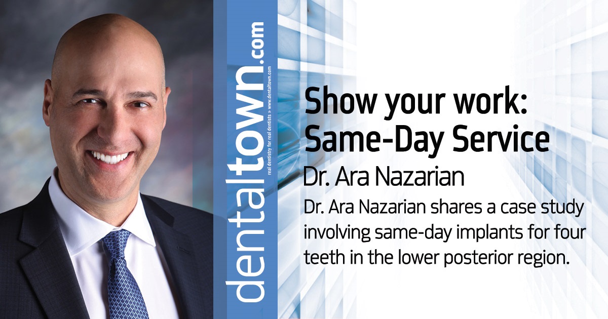 Show your work: Same-Day Service Dr. Ara Nazarian shares a case study involving same-day implants for four teeth in the lower posterior region.