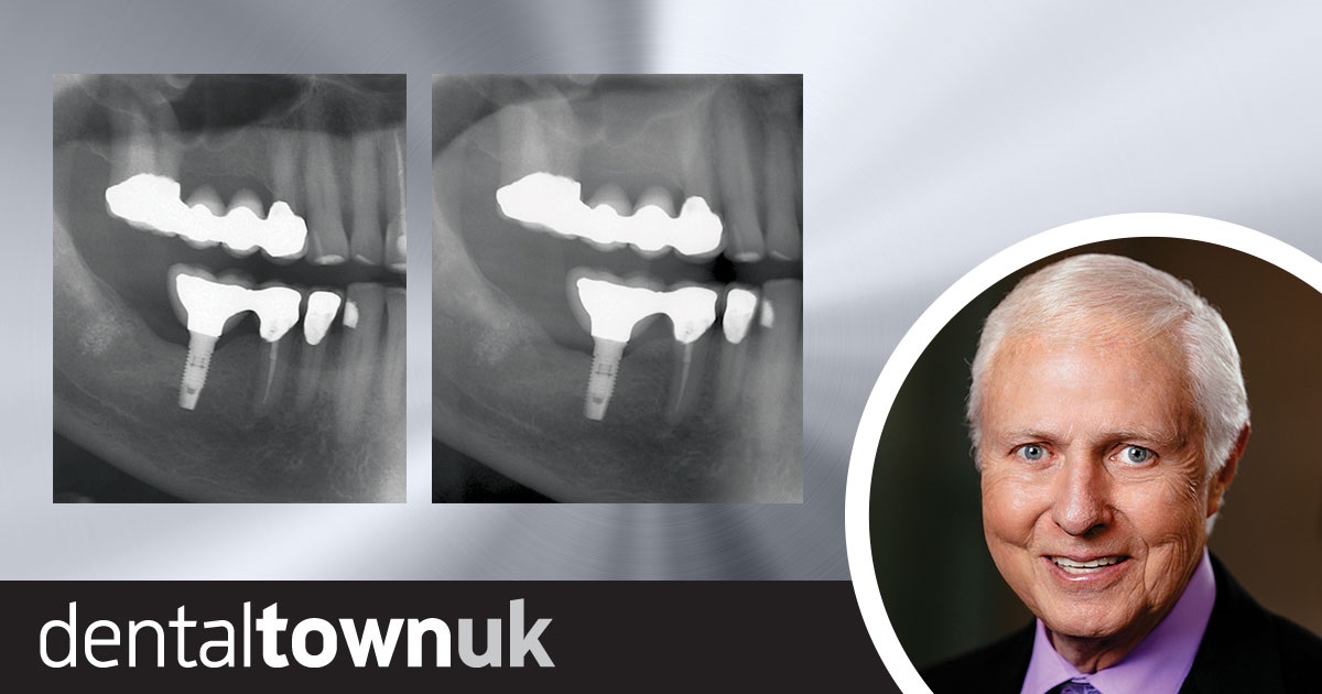 Should Implants Be Connected to Natural Teeth Dr Gordon Christensen shares how, and when, to connect implants to natural teeth.