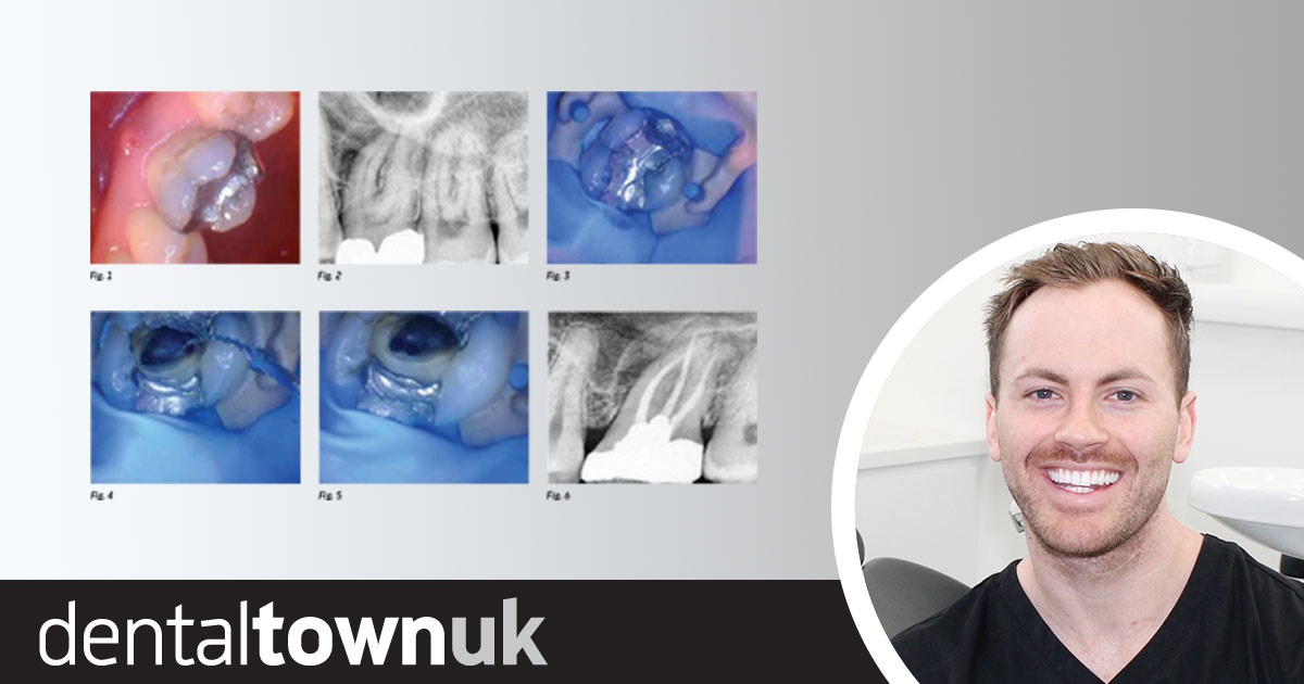 A Single-File Endodontic Case This case demonstrates how a GDP can achieve satisfactory endodontic outcomes using a single-file system