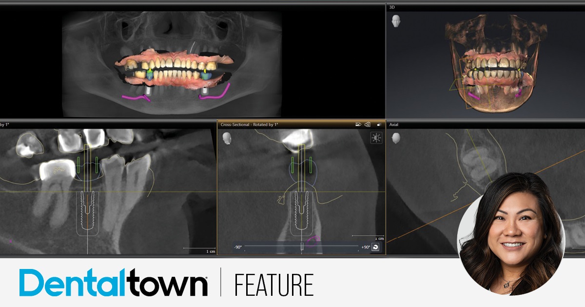 Digitally Guided Implant Placement Dr. Dee Dee Meevasin explains how her practice uses a 3D printer to create surgical guides for implant cases. The result? Cases completed in fewer appointments, with lower failure rates, and eliminated lab delays or production issues. Meevasin also shares a case study to illustrate these principles in action. 