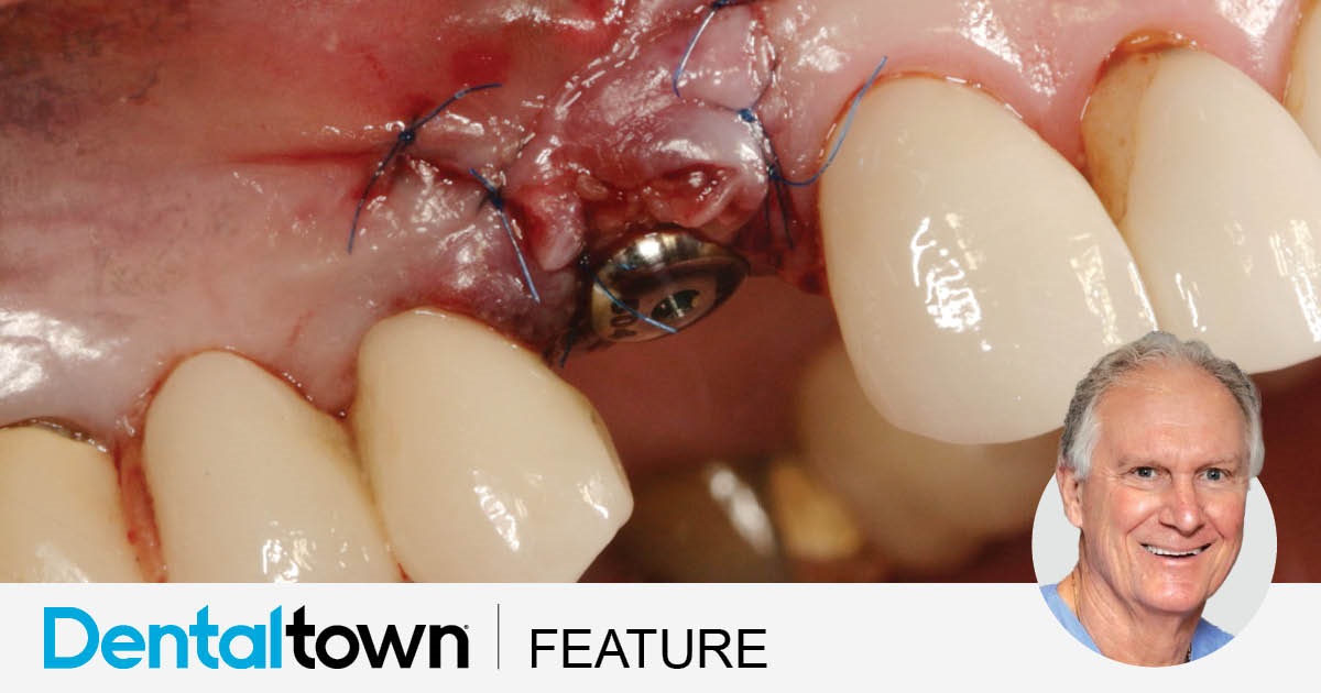 Immediate Results Dr. Emil M. Verban Jr. discusses the factors behind successful immediate implant placement, particularly when it comes to implants being placed in the anterior maxilla. Verban’s recap of the state of the implant industry includes more than 60 images of successful implants, aesthetic failures, proper techniques and more. 
