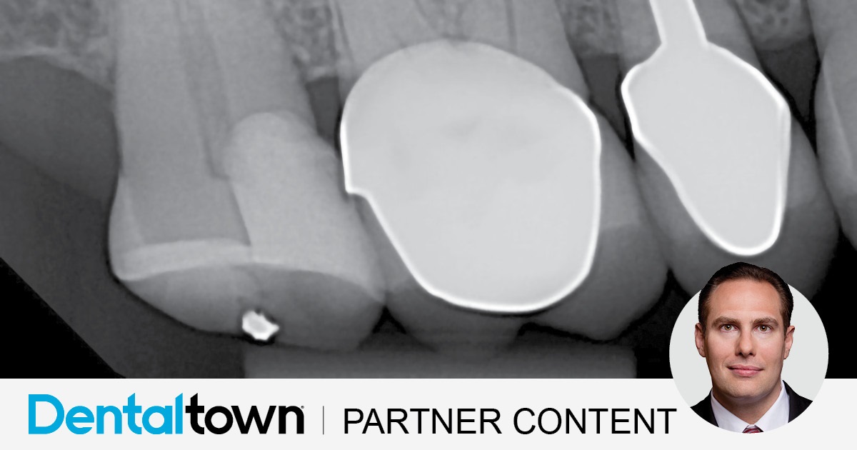 Clinical Case Spotlight: Using the Isolite Pro for a Difficult Posterior Restoration Dr. Arthur R. Volker demonstrates the restoration of a large multisurface direct composite restoration which was facilitated using an isolation system.