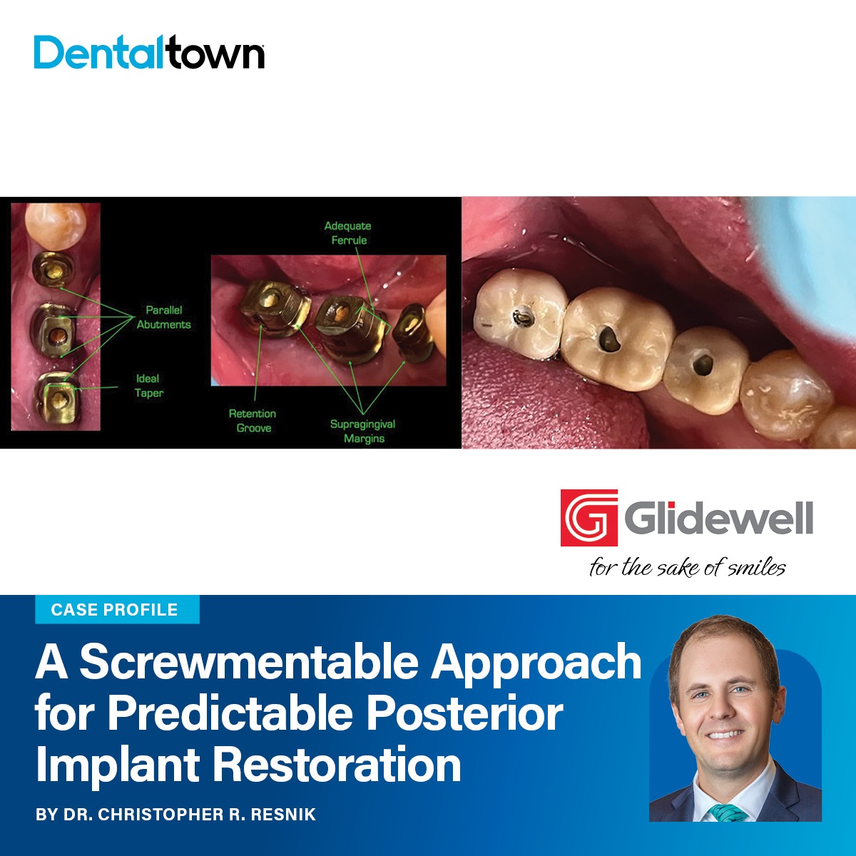 A Screwmentable Approach for Predictable Posterior Implant Restoration A case profile demonstrating how screwmentable restorations combine biologic safety and digital workflows for predictable outcomes in posterior implant cases.