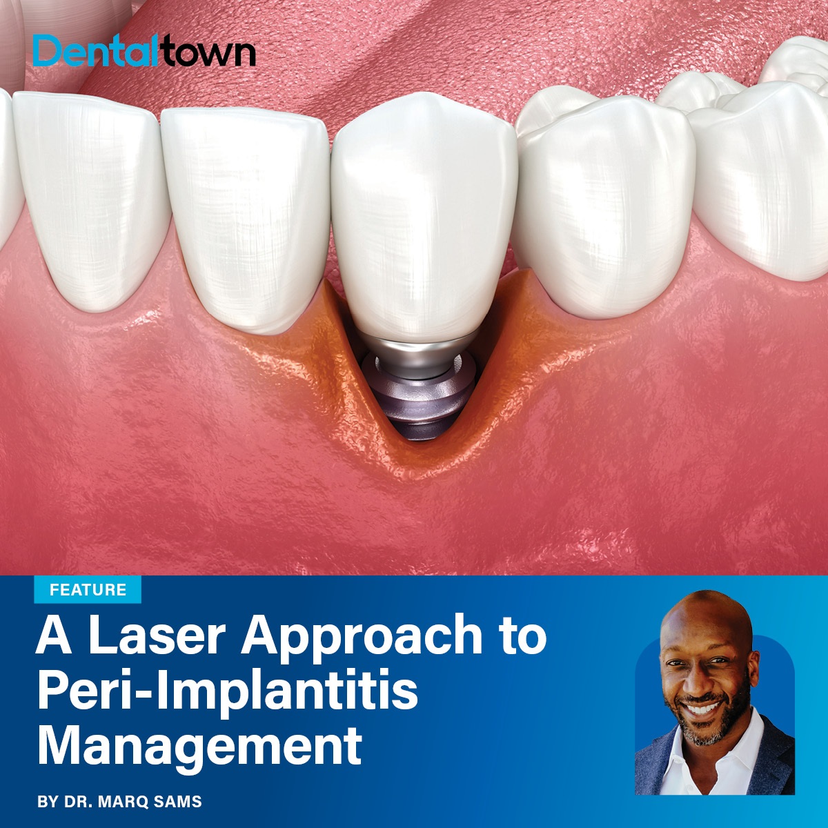 A Laser Approach to Peri-Implantitis Management Dr. Marq Sams discusses how evidence-based laser wavelengths combined with mechanical
debridement can improve peri-implant disease management.