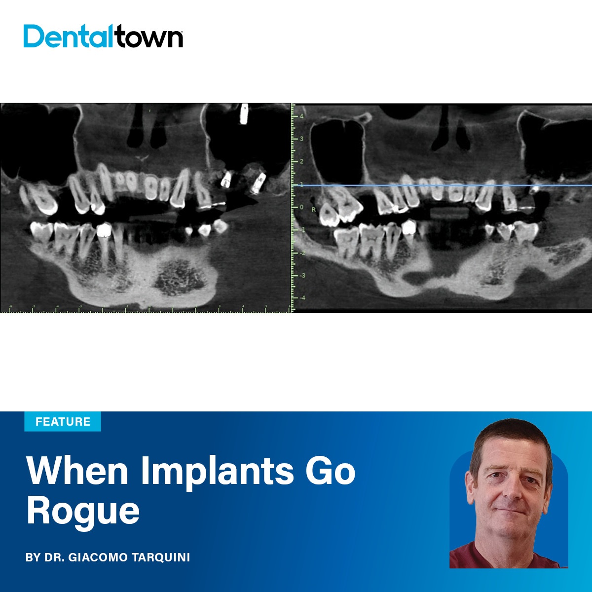 When Implants Go Rogue Dr. Giacomo Tarquini presents a case report on implant migration into the maxillary sinus, covering diagnosis, surgical retrieval, and prevention strategies.