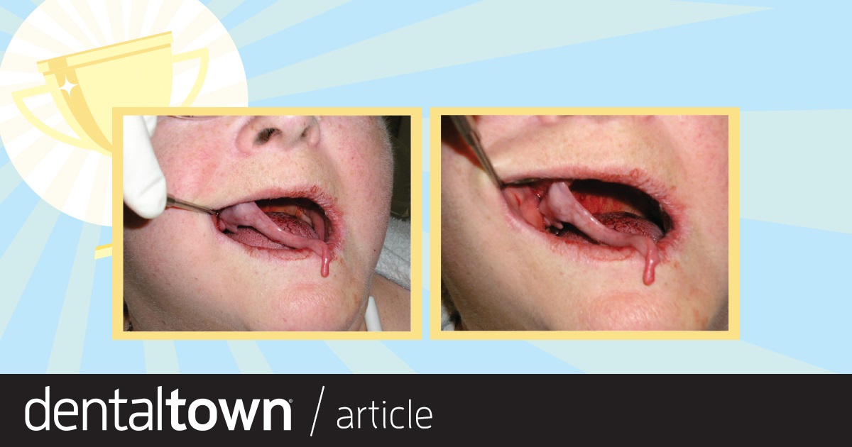 'My Worst Mouth' Contest Results On Dentaltown’s message boards, we asked Townies to submit photos of the most challenging mouths they’ve ever treated. From all the posts, we
selected eight cases to vie for top honors in the “My Worst Mouth” Contest in our January issue. See which case Townies said was the worst of the worst!