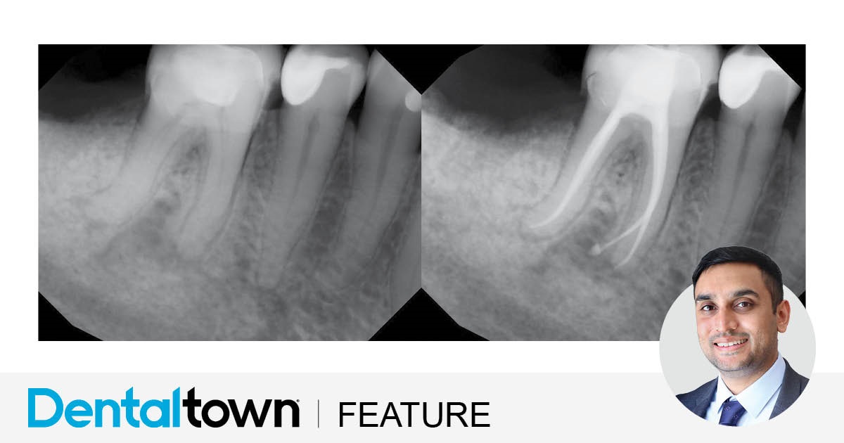 Clinical Case Spotlight: Efficient and Predictable Endodontics Dr. Biraj Patel showcases an endodontic case that provided a streamlined, predictable and efficient treatment by utilizing EdgeFile X7 rotary files and EdgeBioCeramic Sealer.