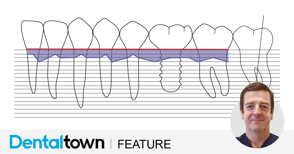 4 Things to Know About Peri-Implantitis Dr. Giacomo Tarquini summarizes peri-implant diseases in four key points and presents a clinical case demonstrating a novel surgical protocol using an ultrasonic device for peri-implantitis.
