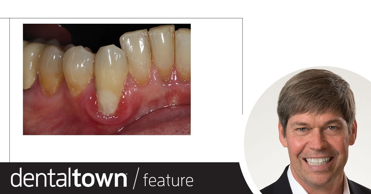 Implants and Occlusal Forces Dr. Jeff Scott discusses the importance of occlusion in implants, including why bite force needs to be evaluated especially with implants, what technology can help assess this, and what dental professionals can do if they don’t have access to certain technologies.