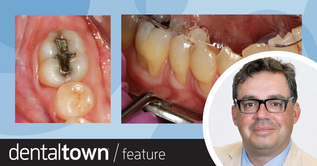 Hold Firm, Or Go With the Flow? Dr. Foroud Hakim shares a decision-making rubric for composite viscosity selection, including the varying materials’ prevalence in practice (Classes I–IV), traditional training axioms and material selection, and contemporary shifts in materials and protocols. 