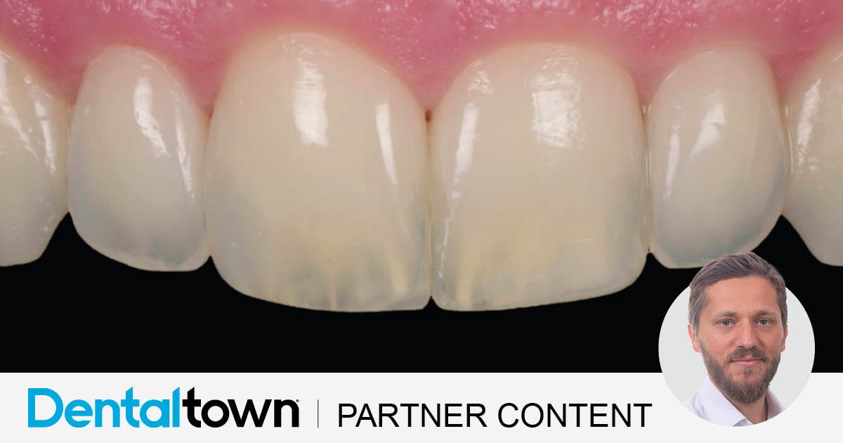 Clinical Case Spotlight: Enhancing Smile Aesthetics Through Precision Layering Dr. Tommaso Mascetti demonstrates a precision layering
technique to achieve seamless shade matching and natural
aesthetics in conservative smile enhancements.