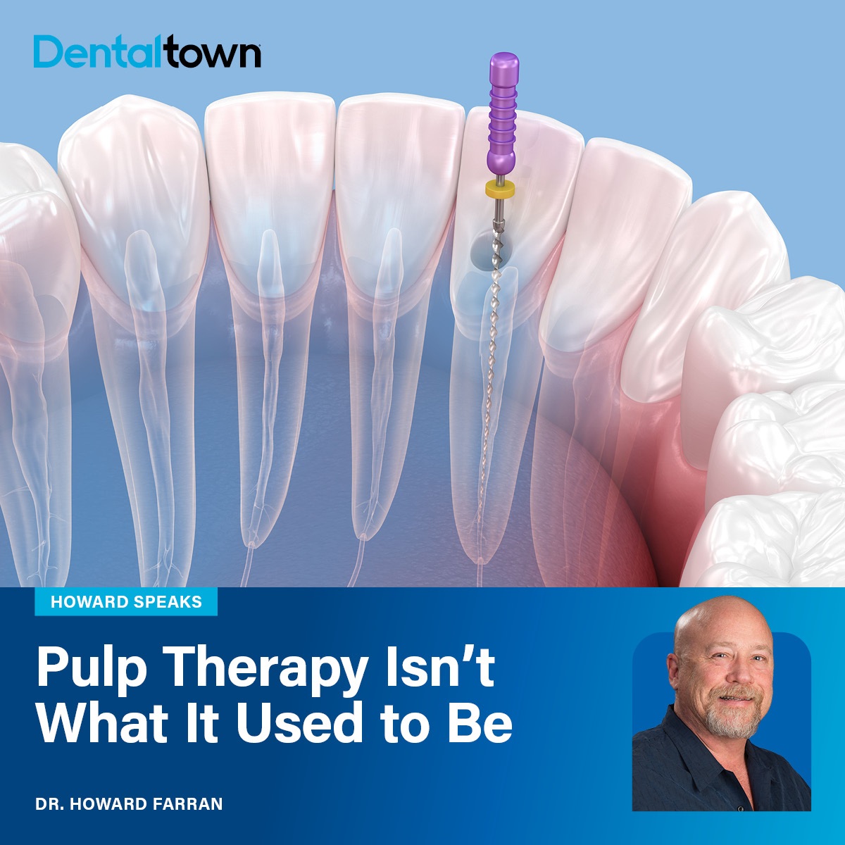 Howard Speaks: Pulp Therapy Isn’t What It Used to Be Dr. Howard Farran discusses what every dentist should know about vital pulp therapy, bioceramics, and the new endodontic mindset.