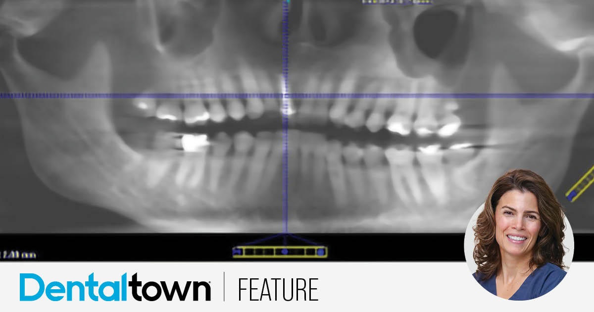 Show Your Work: A Collaborative Effort on 3 Fronts This multidisciplinary treatment plan from Dr. Elizabeth DiBona features elements of digital planning, oral surgery, orthodontics and classic restorative principles. DiBona discusses the case’s various considerations and showcases a collaborative outcome the patient loved.