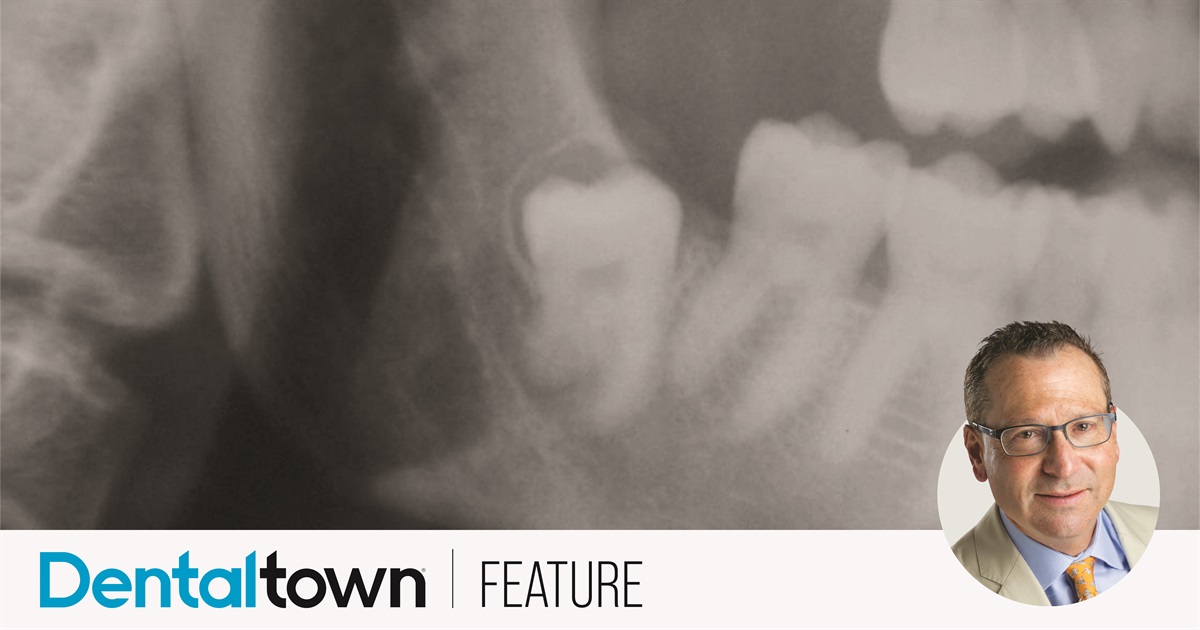 Prophylactic Removal of Third Molars Dr. Jay B. Reznick, an oral surgeon and a member of Dentaltown’s editorial advisory board, examines the cases for and against prophylactic removal of asymptomatic third molars—and how conventional wisdom has changed over the years.