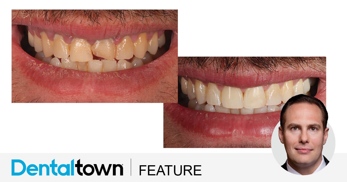 Show Your Work: Full-Contour Veneers and a Fantastic Hygienist Dr. Arthur R. Volker shares a case study of a patient who hadn’t been to a dentist for more than 15 years and came in with
a fractured front tooth.