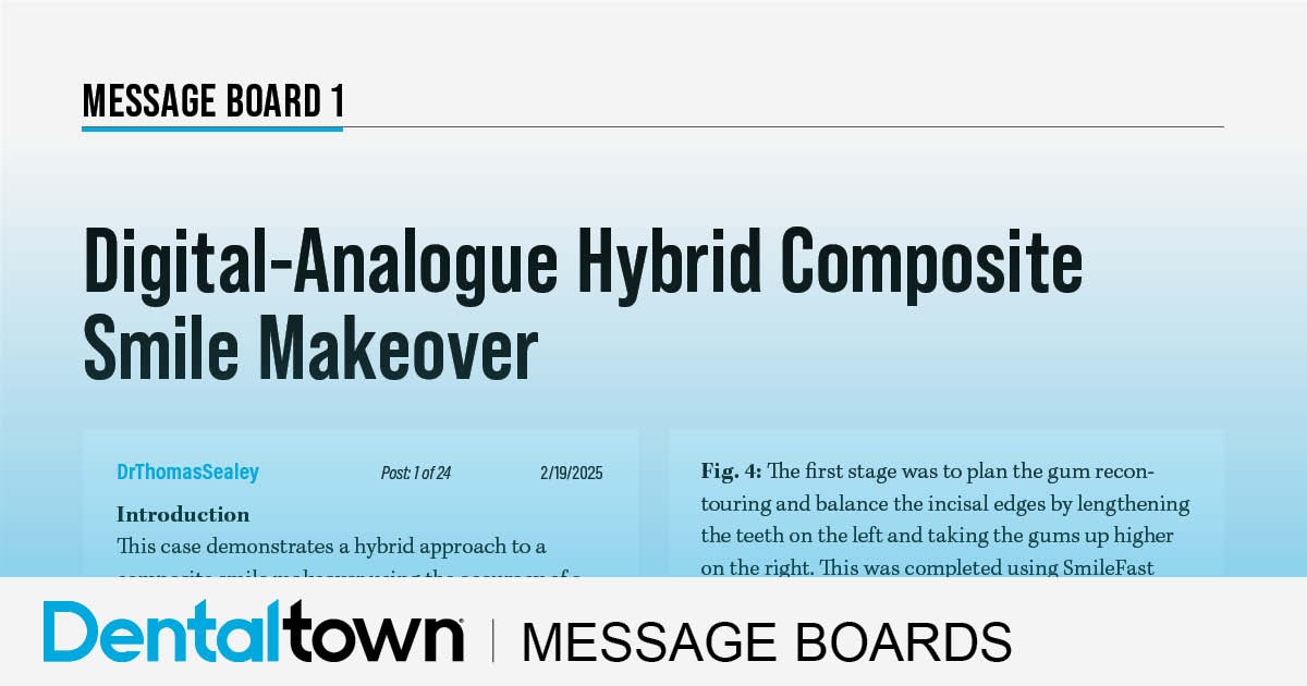 Digital-Analogue Hybrid Composite Smile Makeover A Townie presents a hybrid digital-analog technique that blends planning precision with artistic layering to deliver natural-looking composite veneers in a single appointment.