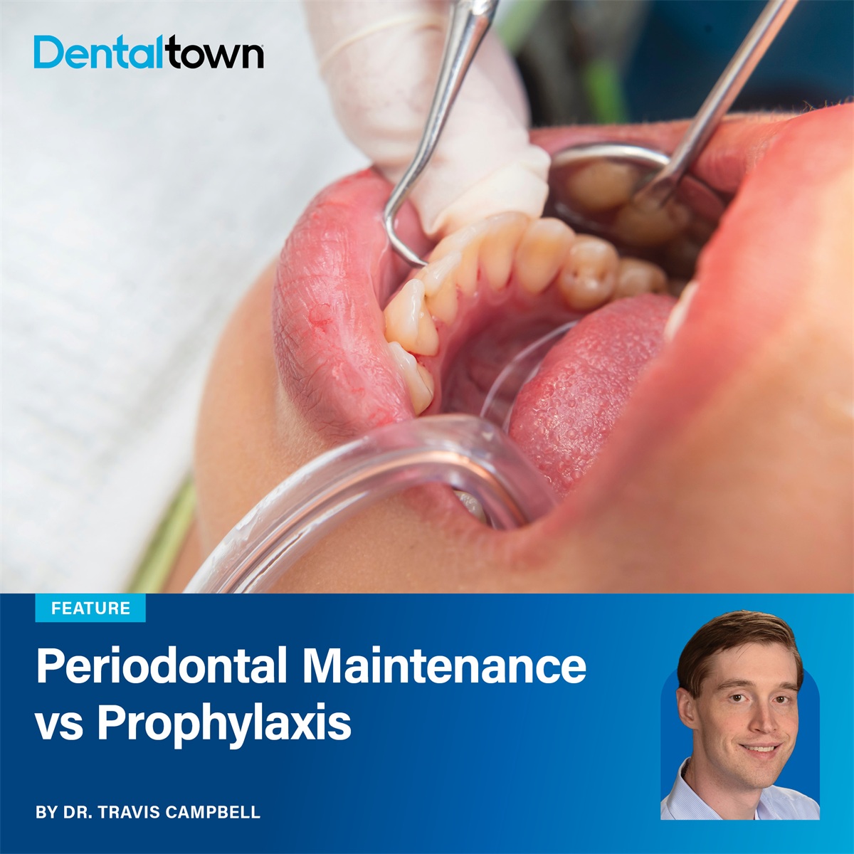Periodontal Maintenance (PM) vs Prophylaxis (PX) Dr. Travis Campbell cuts through the clinical debate to examine the practical insurance, financial, and patient-perception risks of alternating D4910 (PM) and D1110 (PX) codes.