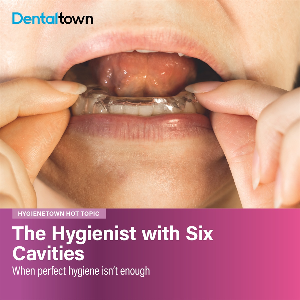 The Hygienist with Six Cavities When a hygienist with excellent oral hygiene presents with multiple cavities, something unusual is going on. The overlooked role of night guards, retainers and aligners in creating an acidic environment that brushing can't fix.