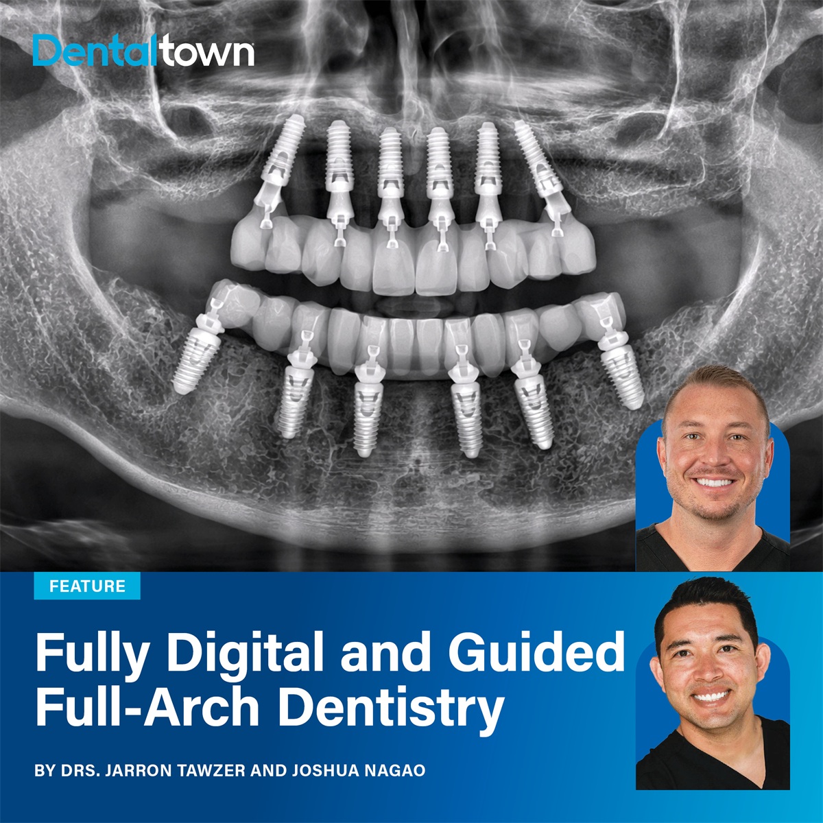 Fully Digital and Guided Full-Arch Dentistry Drs. Jarron Tawzer and Joshua Nagao walk through a complete digital full-arch implant case, showing how precise planning, guided surgery, and photogrammetry combine to produce predictable, reproducible results.
