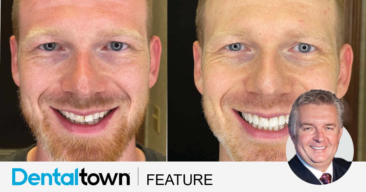 Less Is More: Highly Aesthetic, Minimally Invasive Veneers Improvements in restorative materials and conservative techniques offer clinicians the ability to deliver highly aesthetic results using minimally invasive or no-preparation veneers to restore smiles and even straighten misaligned teeth. Dr. John Heimke explains more and shares a patient case study with a custom-designed smile featuring 18 minimally invasive veneers. 