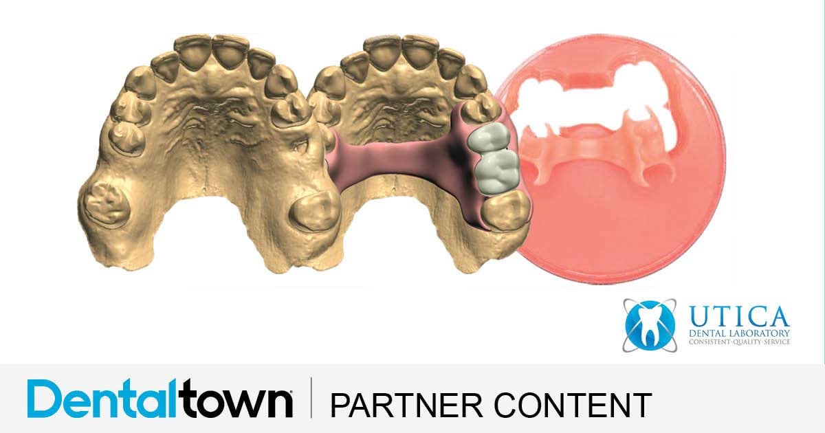 Product Profile: TCS 3D Flexible Partials A complete digital solution for partial dentures from Utica Dental Lab.