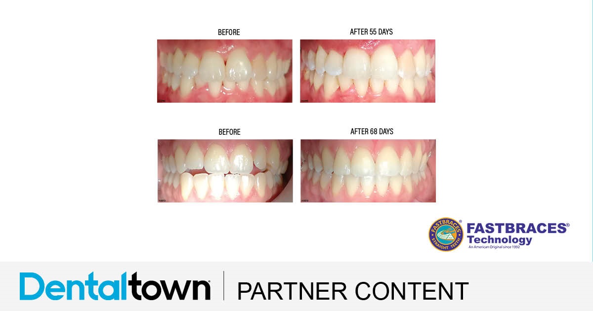 Product Profile: Fastbraces The next generation of orthodontic movement in days