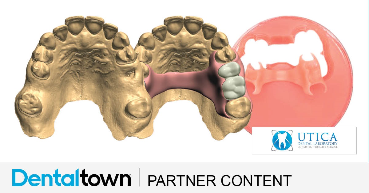 Product Profile: TCS 3D Flexible Partials A complete digital solution for partial dentures