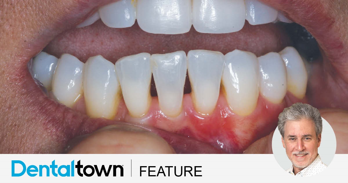 Show Your Work: Filling the Gaps Dr. Robert Rosenfeld shares a case in which he treated the dreaded “black triangles” on a patient’s front teeth, using a specialized matrix kit and a composite with chameleon-like qualities. 