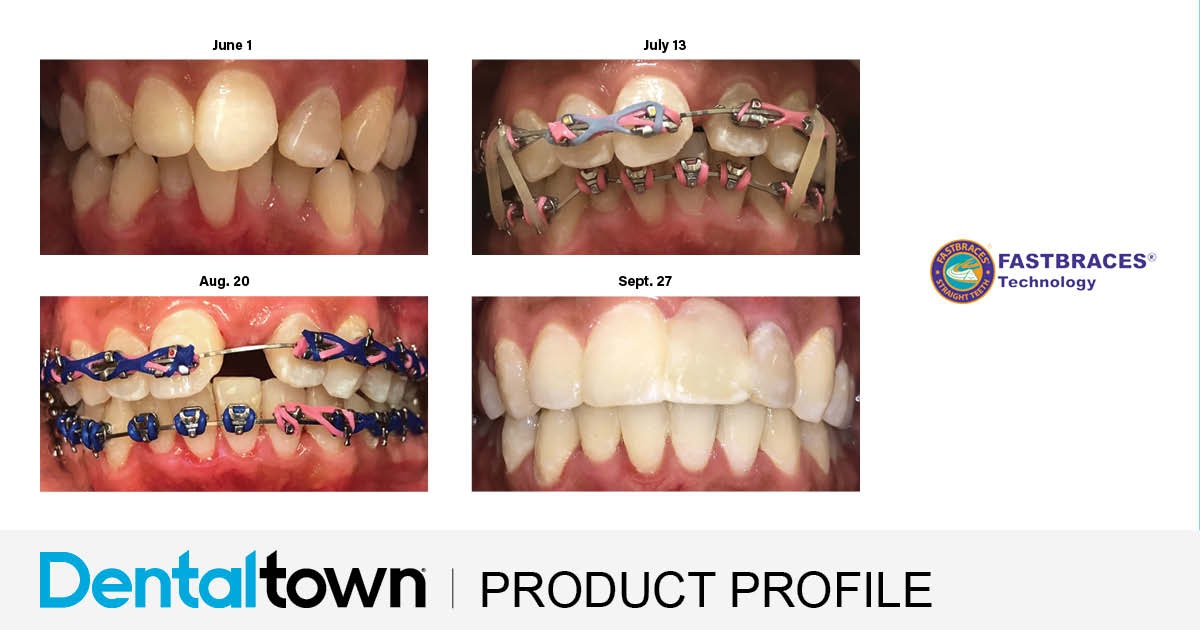Product Profile: Fastbraces Making spaces for implants in about 100 days