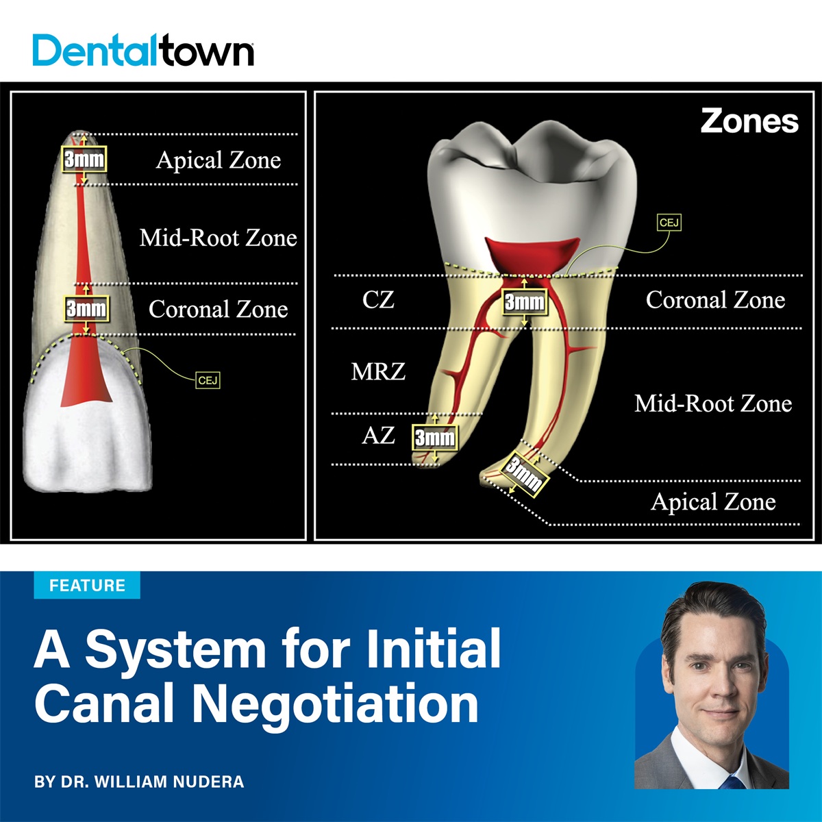 A System for Initial Canal Negotiation Dr. William Nudera presents a structured six-step framework for canal negotiation that transforms an intimidating procedure into a logical, predictable clinical workflow.