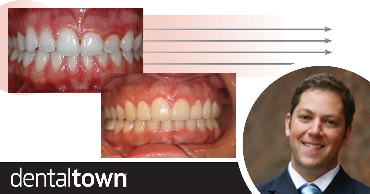 Aesthetic Crown Lengthening In this follow-up to his February 2018 article on functional crown lengthening, Denver periodontist and Dentaltown board member Dr. Brian Gurinsky explains why you should lengthen a crown for aesthetic reasons. 