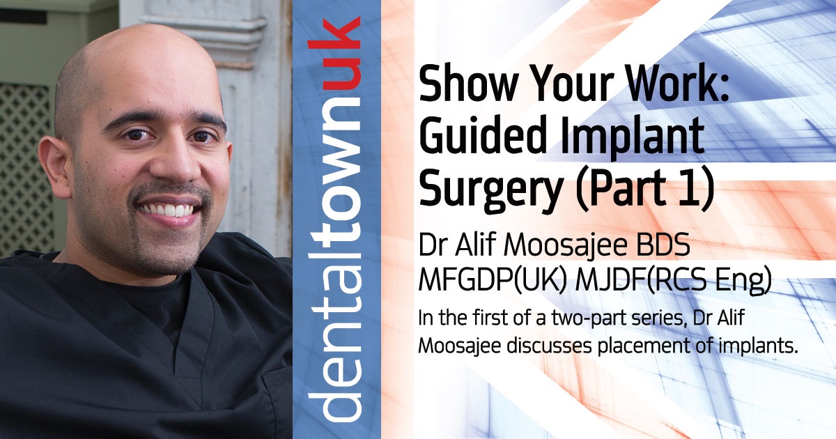 Show Your Work: Guided Implant Surgery (Part 1) In this first of a two-part series, the placement of implants using a surgical guide is detailed with a case illustrating key points