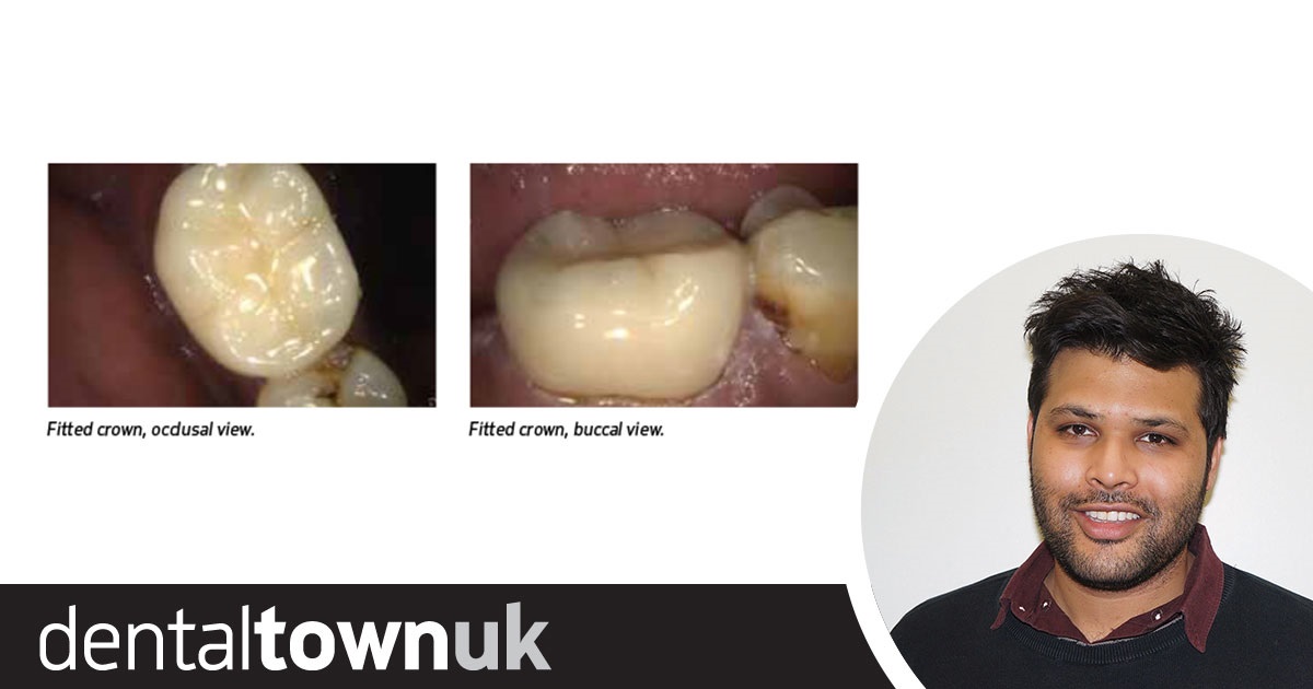 Partner Content: Harnessing Digital Technology to Capture More Detail Dr Kunal Shah describes a case where he used an intraoral scanner to treat a case of chronic apical periodontitis.