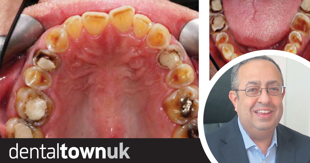 Managing Tooth Wear Through Effective Communication Professor Andrew Eder explores how to communicate effectively with patients about tooth wear.