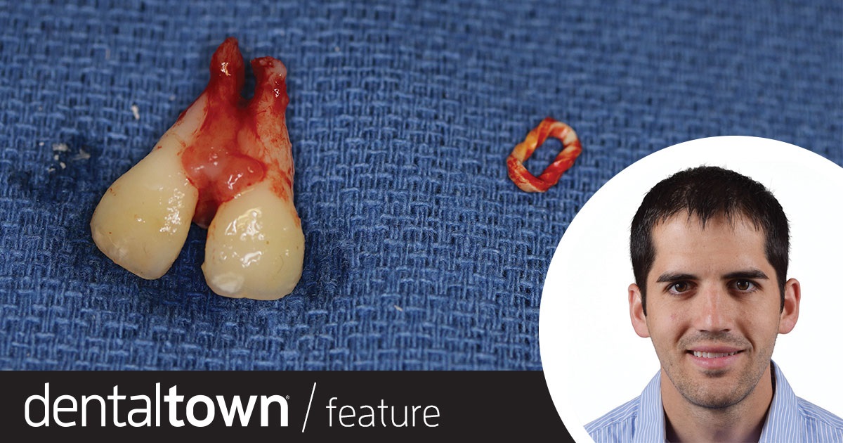 Errant Elastic Extrudes 2 Teeth Dr. Michael Daetwyler, a surgeon in the oral and maxillofacial surgery clinic at UCSF Fresno, shares a case in which a young patient’s severe bone loss, tooth mobility and soft-tissue lesion were caused by an unexpected factor.