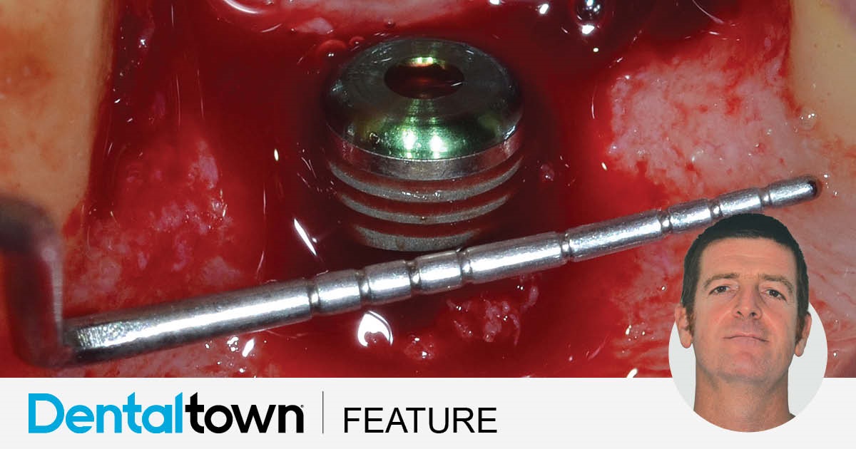 Peri-Implant Guided Bone Regeneration Dr. Giacomo Tarquini’s case study illustrates the use of a novel flex cortical sheet barrier membrane to stabilize the graft and prevent micromovements that could hinder the bone regeneration process. 