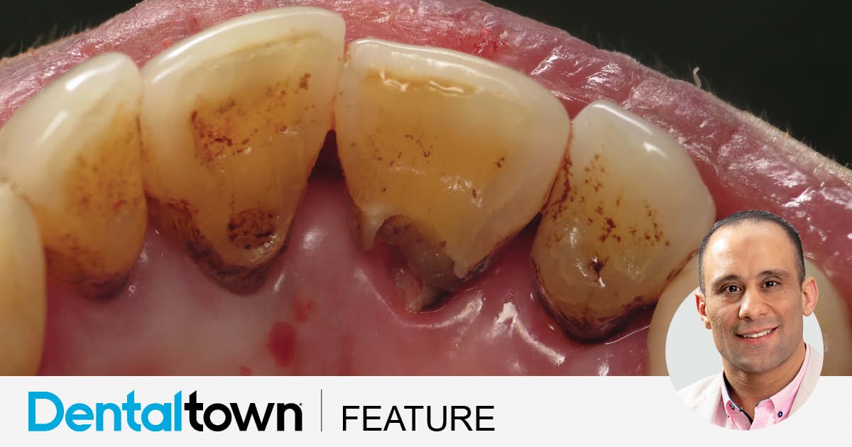 Show Your Work: Restoring Deep Root Caries Dr. Ahmad Fayad shares a conservative technique that mitigates cost barriers without sacrificing patient care.