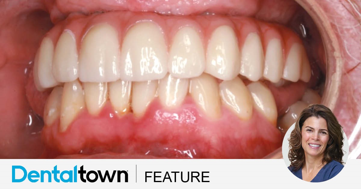 Show Your Work: A Traditional Touch to All-on-X Treatment Dr. Elizabeth DiBona shares an implant case in which she treated a patient whose debilitating dental phobia had led to extensive caries, black staining, bone loss and periodontal disease. Her All-on-X case includes a 2½-year follow-up.