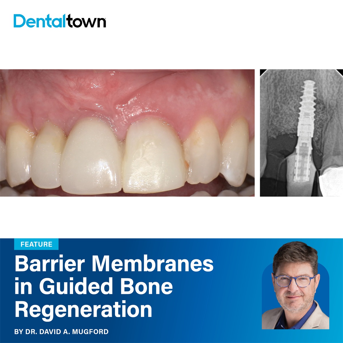 Barrier Membranes in Guided Bone Regeneration Dr. David A. Mugford presents a clinical framework for matching membrane selection to
defect morphology, site timing, and exposure risk in guided bone regeneration.