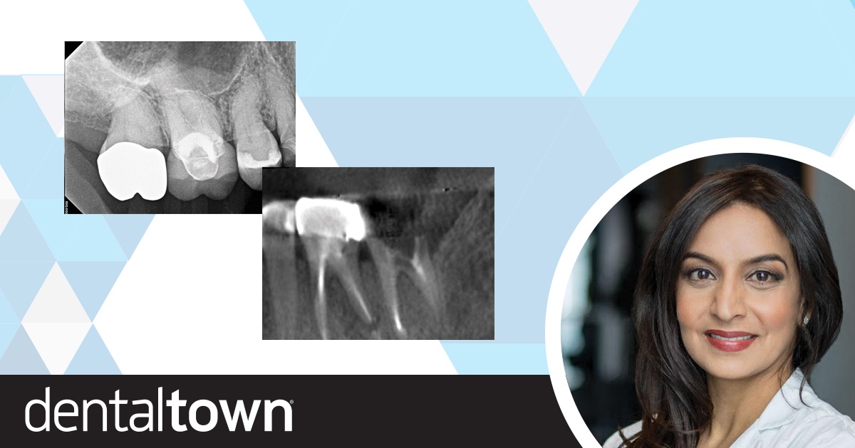 The Cone Beam Conversation Townie endodontist Dr. Sonia Chopra shares the top five reasons she believes it’s well worth a dental professional’s effort to add cone beam technology (and invest the time it takes to learn it).